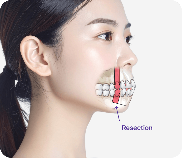 id Hospital - Three-Jaw Surgery - Protrusion Correction