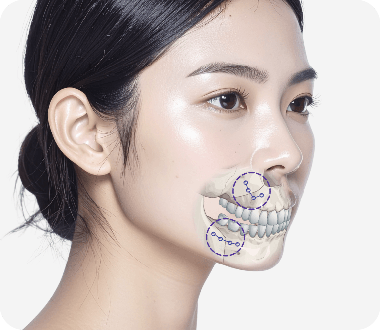 id Hospital - Three-Jaw Surgery - Receding Chin Improvement