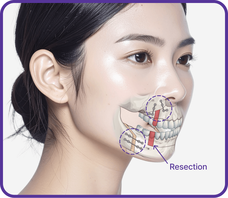 id Hospital - Three-Jaw Surgery - Three-Jaw Surgery Result