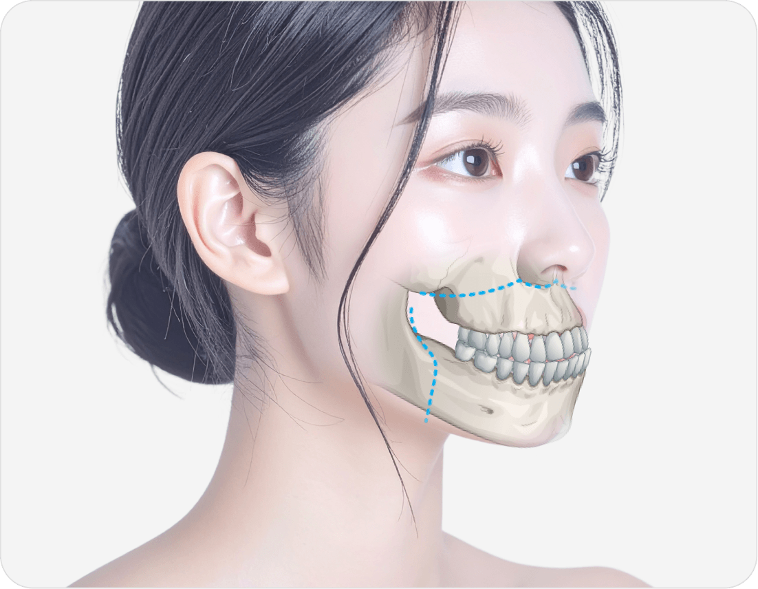 id Hospital - Surgery First Approach Orthognathic Surgery - Traditional Two-Jaw Surgery