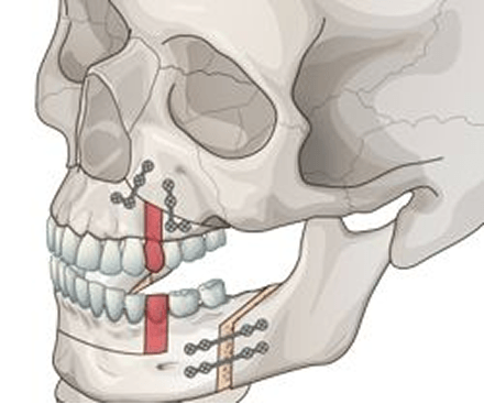 id Hospital - Surgery First Approach Orthognathic Surgery - Maxillary and Mandibular Osteotomy Using MSS