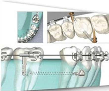 id Hospital - Surgery First Approach Orthognathic Surgery - Excellent Orthodontic Treatment Effect Through SAS