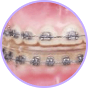 id Hospital - Surgery-First Approach Orthognathic Surgery - Traditional - Orthodontic treatment period before surgery 1 year and 6 months