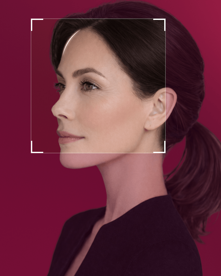 Endotine Forehead Lift