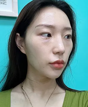 id Hospital - id Real Selfie - Seoyoon Lim Before