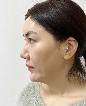 id Hospital - id Real Selfie - Jihye Choi Before