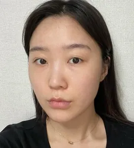 id Hospital - id Real Selfie - Emily Before